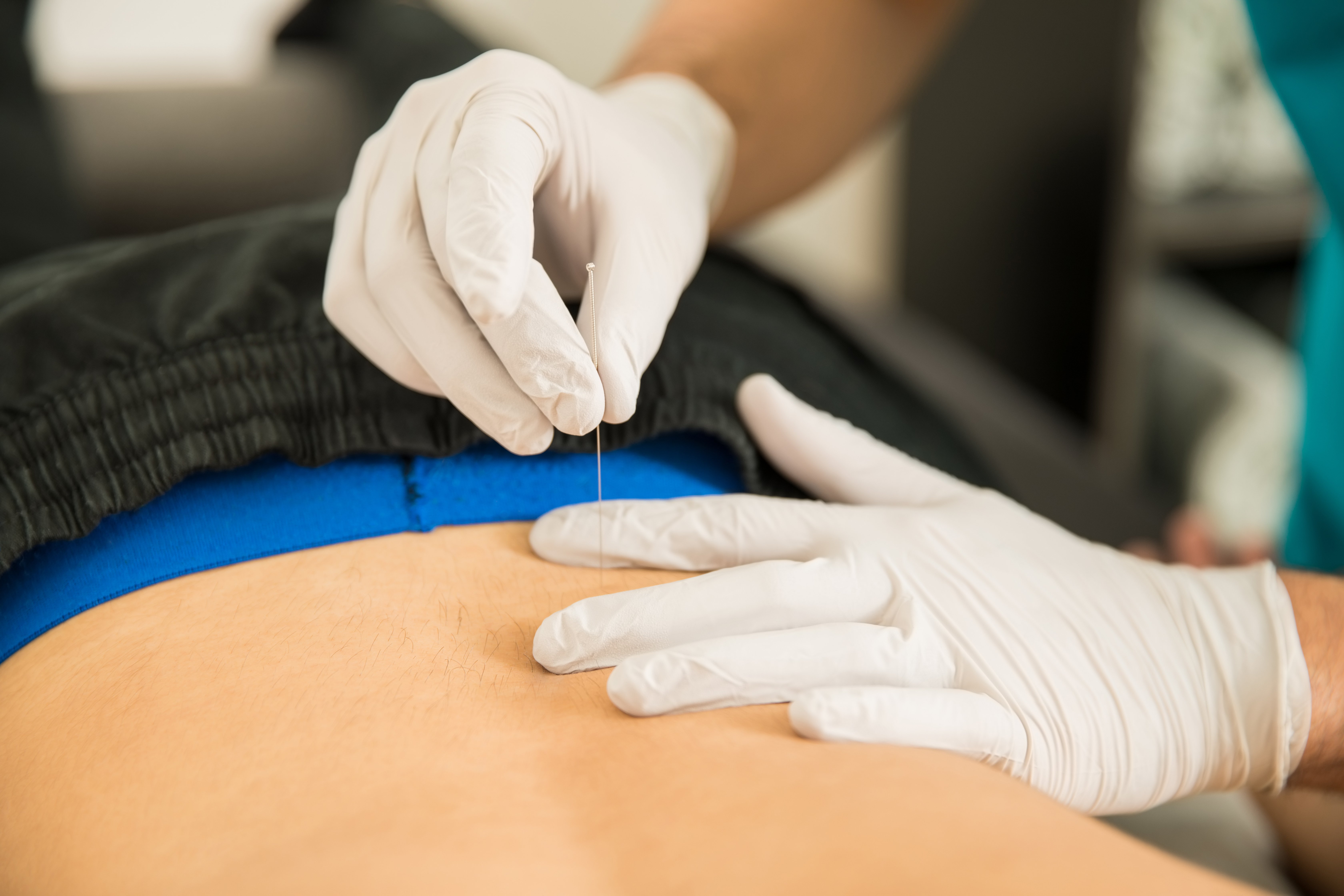 dry needling