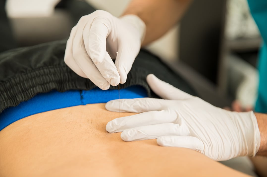 dry needling