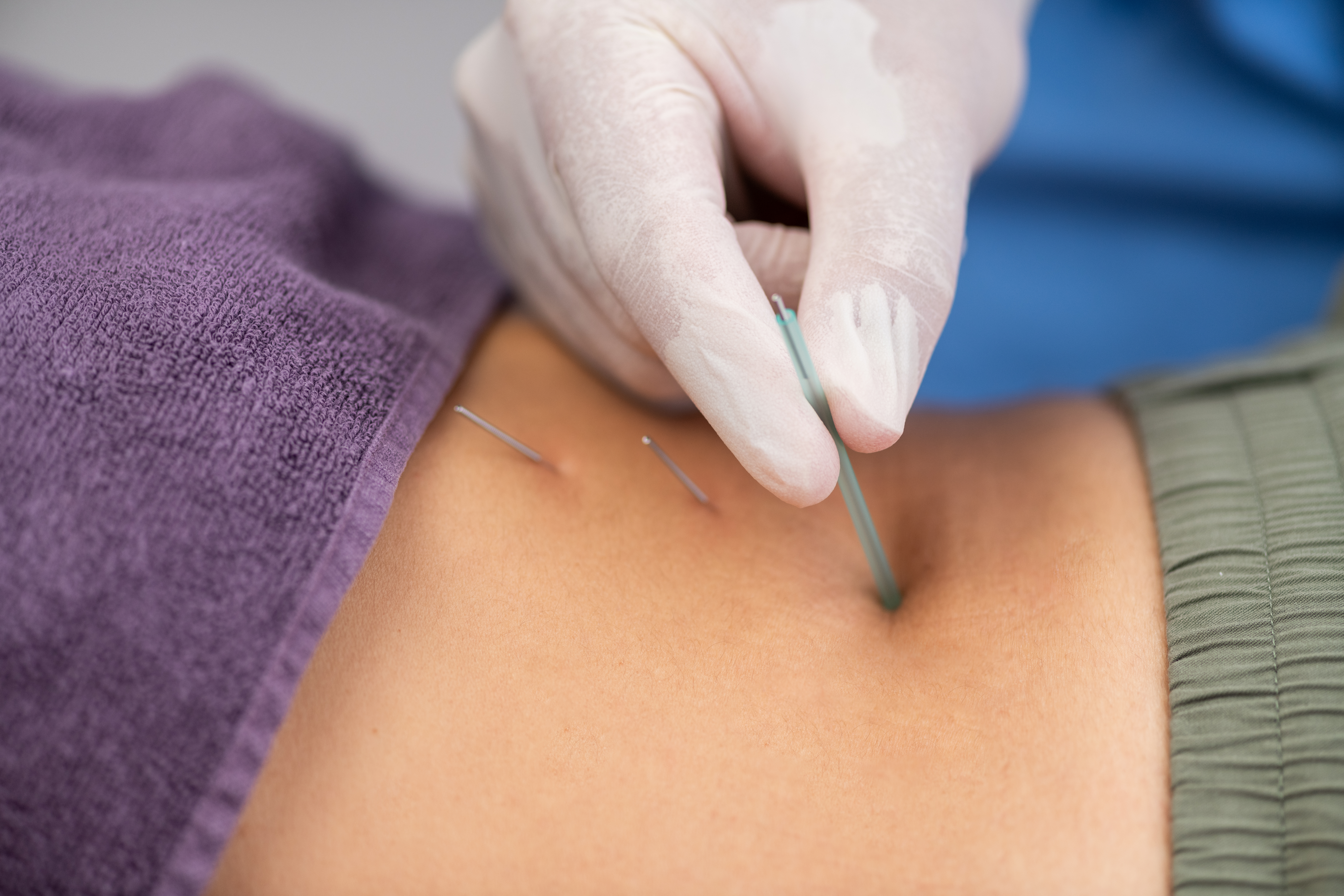 dry needling